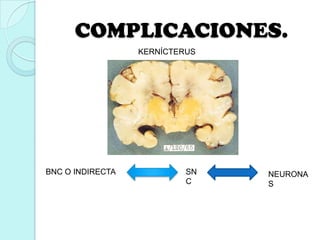 COMPLICACIONES.
KERNÍCTERUS
BNC O INDIRECTA SN
C
NEURONA
S
 