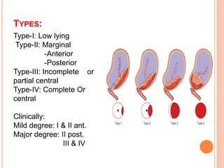 TYPES:
Type-I: Low lying
Type-II: Marginal
-Anterior
-Posterior
Type-III: Incomplete or
partial central
Type-IV: Complete Or
central
Clinically:
Mild degree: I & II ant.
Major degree: II post.
III & IV
 