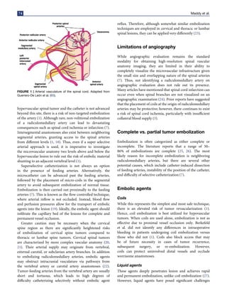 74 Maddy et al.
FIGURE 1 | Arterial vasculature of the spinal cord. Adapted from
Guerrero-De León et al. (65).
hypervascular spinal tumor and the catheter is not advanced
beyond this site, there is a risk of non-targeted embolization
of the artery (1). Although rare, non-volitional embolization
of a radiculomedullary artery can lead to devastating
consequences such as spinal cord ischemia or infarction (7).
Intersegmental anastomoses also exist between neighboring
segmental arteries, granting access to the spinal arteries
from different levels (1, 18). Thus, even if a super selective
arterial approach is used, it is imperative to investigate
the microvascular anatomy two levels above and below the
hypervascular lesion to rule out the risk of embolic material
shunting to an adjacent vertebral level (1).
Superselective catheterization is not always an option
in the presence of feeding arteries. Alternatively, the
microcatheter can be advanced past the feeding arteries,
followed by the placement of micro-coils in the segmental
artery to avoid subsequent embolization of normal tissue.
Embolization is then carried out proximally to the feeding
arteries (7). This is known as the flow-controlled technique,
where arterial inflow is not occluded. Instead, blood flow
and perfusion pressures allow for the transport of embolic
agents into the lesion (19). Ideally, the embolic agent should
infiltrate the capillary bed of the lesions for complete and
permanent vessel occlusion.
Greater caution may be necessary when the cervical
spine region as there are significantly heightened risks
of embolization of cervical spine tumors compared to
thoracic or lumbar spine tumors. Cervical spinal tumors
are characterized by more complex vascular anatomy (20,
21). Their arterial supply may originate from vertebral,
external carotid, or subclavian artery branches. In addition
to embolizing radiculomedullary arteries, embolic agents
may obstruct intracranial vasculature via pathways from
the vertebral artery or carotid artery anastomoses (22).
Tumor-feeding arteries from the vertebral artery are usually
short and tortuous, which leads to high degrees of
difficulty catheterizing selectively without embolic agent
reflux. Therefore, although somewhat similar embolization
techniques are employed in cervical and thoracic or lumbar
spinal lesions, they can be applied very differently (23).
Limitations of angiography
While angiographic evaluation remains the standard
modality for obtaining high-resolution spinal vascular
anatomy imaging, they are limited in their ability to
completely visualize the microvascular infrastructure given
the small size and overlapping nature of the spinal arteries
(7). Thus, not identifying a radiculomedullary artery on
angiographic evaluation does not rule out its presence.
Many articles have mentioned that spinal cord infarction can
occur even when spinal branches are not visualized on an
angiographic examination (24). Prior reports have suggested
that the placement of coils at the origin of radiculomedullary
arteries may be protective; however, there continues to exist
a risk of spinal cord ischemia, particularly with insufficient
collateral blood supply (3).
Complete vs. partial tumor embolization
Embolization is often categorized as either complete or
incomplete. The literature reports that a range of 50–
86% of embolizations are complete (25, 26). The most
likely reason for incomplete embolization is neighboring
radiculomedullary arteries, but there are several other
potential causes, which include catheter-induced dissection
of feeding arteries, instability of the position of the catheter,
and difficulty of selective catheterization (7).
Embolic agents
Coils
While this represents the simplest and most safe technique,
there is an elevated risk of tumor revascularization (1).
Hence, coil embolization is best utilized for hypovascular
tumors. When coils are used alone, embolization is not as
effective due to proximal vessel occlusion only. Berkefeld
et al. did not identify any differences in intraoperative
bleeding in patients undergoing coil embolization versus
those who did not (1). Coils also block access that may
be of future necessity in cases of tumor recurrence,
subsequent surgery, or re-embolization. However,
coils can protect uninvolved distal vessels and occlude
worrisome anastomoses.
Liquid agents
These agents deeply penetrates lesion and achieves rapid
and permanent embolization, unlike coil embolization (27).
However, liquid agents have posed significant challenges
 