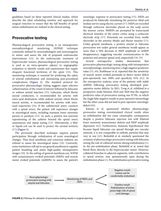 78 Maddy et al.
guidelines based on these reported clinical studies, which
describe the ideal scheduling timeline and approach for
surgical resection to ensure that the full benefits of spinal
tumor embolization are realized in the clinical setting.
Provocative testing
Pharmacological provocative testing is an intraoperative
neurophysiological monitoring (IONM) technique
commonly utilized by neuroradiologists and neurosurgeons
to mimic and assess the risk of proposed endovascular
interventions (54). In the endovascular treatment of
hypervascular tumors, pharmacological provocative testing
is used as an intra-operative adjunct to angiographic
evaluation to identify vessels and anastomoses that supply
eloquent functional territories of the spine (54). This
monitoring technique is essential for predicting the safety
of arterial embolization and minimizing post-procedural
complications (Figure 2). The standard protocol for
provocative pharmacologic testing suggests super selective
catheterization of the vessel of interest followed by lidocaine
or sodium amytal injection (55). Lidocaine, which blocks
axonal conduction, is recommended for arteries with
extra-axial destination, while sodium amytal, which blocks
neural activity, is recommended for arteries with intra-
axial trajectories (56). If the catheterized artery connects
with a spinal artery, the patient will experience changes
in neurological status, including transient lower extremity
paresis or paralysis (55). As such, a positive test warrants
repositioning of the catheter beyond the spinal artery
anastomosis and repeat testing (55). Alternatively, a fiber
or liquid coil can be used to protect the normal territory
(57) (Figure 3).
The previously described technique requires patient
participation through verbalization of acute neurological
changes. Thus local anesthesia and conscious sedation are
utilized to assess the neurological status (58). Contrarily,
some institutions will opt to use general anesthesia to regulate
patient breathing and attain high-quality intraoperative
images (58). In the setting of general anesthesia use, IONM
with somatosensory evoked potentials (SSEPs) and muscle
motor evoked potentials (mMEPs) to assess the patient’s
neurologic response to provocative testing (55). SSEPs are
produced by bilaterally stimulating the posterior tibial and
median nerves using electric current (57). SSEPs are recorded
through corkscrew electrodes placed on the scalp across
the sensory cortex. MMEPs are prompted by transcranial
electrical stimulus of the motor cortex using a corkscrew
electrode strip (57). Potentials are recorded from needle
electrodes in the anterior tibialis and thenar muscles (57).
Under general anesthesia, a positive amytal or lidocaine
provocative test under general anesthesia would appear as
more than a 50% decrease in SSEP amplitude or mMEP
disappearance, suggesting vascular communication to the
posterior and anterior spinal cord, respectively (58, 59).
Several retrospective studies demonstrate that
provocative pharmacologic testing along with intraoperative
neurophysiologic monitoring have a high negative predictive
value (55, 60). Kothbauer et al. reported that the sensitivity
of muscle motor evoked potentials to detect motor deficit
post-operatively was 100% and specificity 91% (61). In
the retrospective analysis, none of the patients with stable
mMEPs following provocative testing developed post-
operative motor deficits. In 2021, Tong et al. exhibited in a
prospective study between 2018 and 2020 that the negative
predictive value of provocative testing was 97.9%, in which
the single false negative results in post-operative hemorrhage
but the other cause did not lead to post-operative neurologic
deficit (60).
Katsuta et al. questioned whether pharmacologic
provocative testing overstimulated clinical results when
an embolization did not cause catastrophic consequences
despite a positive lidocaine injection test with bilateral
lower extremity sensorimotor deficits and SSEP amplitude
depression (62). Furthermore, Katasuta hypothesized that
because liquid lidocaine can spread through any vascular
network, it is not comparable to embolic particles that may
vary in size (62). Berkefeld et al. similarly questioned the
certainty of pharmacologic provocative testing with lidocaine
noting the role of collateral arteries during embolization (1).
In the pre-embolization phase, Berkefeld et al. noted that
blood flows directly to the hypervascular tumor. However,
collateral branches to adjacent segments, with contributions
to spinal arteries, may spontaneously open during the
embolization phase (1). Pre-embolization provocative testing
FIGURE 2 | Pathway for utilization of provocative testing results in surgical planning.
 