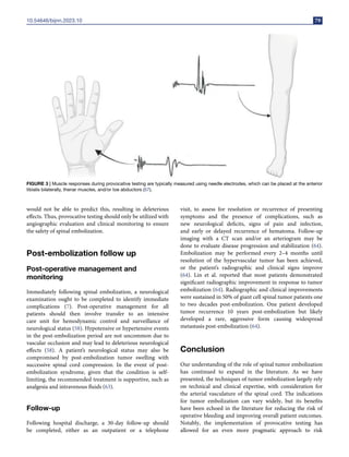 10.54646/bijnn.2023.10 79
FIGURE 3 | Muscle responses during provocative testing are typically measured using needle electrodes, which can be placed at the anterior
tibialis bilaterally, thenar muscles, and/or toe abductors (57).
would not be able to predict this, resulting in deleterious
effects. Thus, provocative testing should only be utilized with
angiographic evaluation and clinical monitoring to ensure
the safety of spinal embolization.
Post-embolization follow up
Post-operative management and
monitoring
Immediately following spinal embolization, a neurological
examination ought to be completed to identify immediate
complications (7). Post-operative management for all
patients should then involve transfer to an intensive
care unit for hemodynamic control and surveillance of
neurological status (58). Hypotensive or hypertensive events
in the post-embolization period are not uncommon due to
vascular occlusion and may lead to deleterious neurological
effects (58). A patient’s neurological status may also be
compromised by post-embolization tumor swelling with
successive spinal cord compression. In the event of post-
embolization syndrome, given that the condition is self-
limiting, the recommended treatment is supportive, such as
analgesia and intravenous fluids (63).
Follow-up
Following hospital discharge, a 30-day follow-up should
be completed, either as an outpatient or a telephone
visit, to assess for resolution or recurrence of presenting
symptoms and the presence of complications, such as
new neurological deficits, signs of pain and infection,
and early or delayed recurrence of hematoma. Follow-up
imaging with a CT scan and/or an arteriogram may be
done to evaluate disease progression and stabilization (64).
Embolization may be performed every 2–4 months until
resolution of the hypervascular tumor has been achieved,
or the patient’s radiographic and clinical signs improve
(64). Lin et al. reported that most patients demonstrated
significant radiographic improvement in response to tumor
embolization (64). Radiographic and clinical improvements
were sustained in 50% of giant cell spinal tumor patients one
to two decades post-embolization. One patient developed
tumor recurrence 10 years post-embolization but likely
developed a rare, aggressive form causing widespread
metastasis post-embolization (64).
Conclusion
Our understanding of the role of spinal tumor embolization
has continued to expand in the literature. As we have
presented, the techniques of tumor embolization largely rely
on technical and clinical expertise, with consideration for
the arterial vasculature of the spinal cord. The indications
for tumor embolization can vary widely, but its benefits
have been echoed in the literature for reducing the risk of
operative bleeding and improving overall patient outcomes.
Notably, the implementation of provocative testing has
allowed for an even more pragmatic approach to risk
 