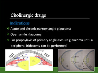 Cholinergic drugs
 Acute and chronic narrow angle glaucoma
 Open angle glaucoma
 For prophylaxis of primary angle-closure glaucoma until a
peripheral iridotomy can be performed
Indications
 