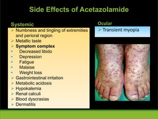 Systemic
 Numbness and tingling of extremities
and perioral region
 Metallic taste
 Symptom complex
 Decreased libido
 Depression
 Fatigue
 Malaise
 Weight loss
 Gastrointestinal irritation
 Metabolic acidosis
 Hypokalemia
 Renal calculi
 Blood dyscrasias
 Dermatitis
Ocular
Transient myopia
Side Effects of Acetazolamide
 