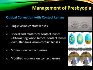 Optical Correction with Contact Lenses
o Single vision contact lenses
o Bifocal and multifocal contact lenses
- Alternating vision bifocal contact lenses
- Simultaneous vision contact lenses
o Monovision contact lenses
o Modified monovision contact lenses
Management of Presbyopia
 
