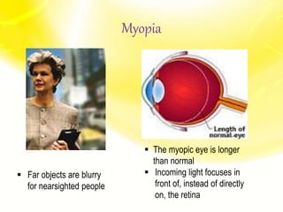 Myopia
 Far objects are blurry
for nearsighted people
 The myopic eye is longer
than normal
 Incoming light focuses in
front of, instead of directly
on, the retina
 