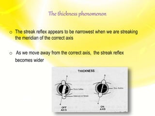 The thickness phenomenon
o The streak reflex appears to be narrowest when we are streaking
the meridian of the correct axis
o As we move away from the correct axis, the streak reflex
becomes wider
 