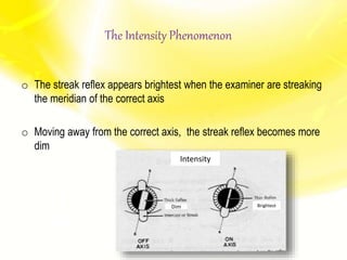 The Intensity Phenomenon
o The streak reflex appears brightest when the examiner are streaking
the meridian of the correct axis
o Moving away from the correct axis, the streak reflex becomes more
dim
Intensity
Dim Brightest
 