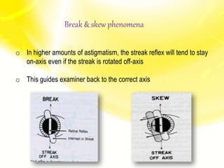 o In higher amounts of astigmatism, the streak reflex will tend to stay
on-axis even if the streak is rotated off-axis
o This guides examiner back to the correct axis
Break & skew phenomena
 