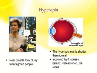 Hyperopia
 Near objects look blurry
to farsighted people
 The hyperopic eye is shorter
than normal
 Incoming light focuses
behind, instead of on, the
retina
 