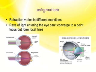 astigmatism
• Refraction varies in different meridians
• Rays of light entering the eye can’t converge to a point
focus but form focal lines
 