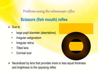Scissors (fish mouth) reflex
 Due to
• large pupil diameter (aberrations)
• Irregular astigmatism
• Irregular retina
• Tilted lens
• Corneal scar
 Neutralized by lens that provides more or less equal thickness
and brightness to the opposing reflex
Problems seeing the retinoscopic reflex
 