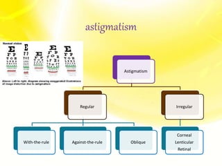 Astigmatism
Regular
With-the-rule Against-the-rule Oblique
Irregular
Corneal
Lenticular
Retinal
astigmatism
 