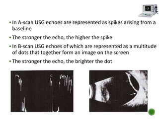  In A-scan USG echoes are represented as spikes arising from a
baseline
 The stronger the echo, the higher the spike
 In B-scan USG echoes of which are represented as a multitude
of dots that together form an image on the screen
 The stronger the echo, the brighter the dot
 