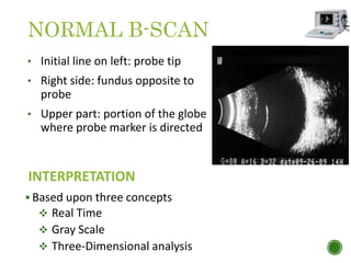 NORMAL B-SCAN
• Initial line on left: probe tip
• Right side: fundus opposite to
probe
• Upper part: portion of the globe
where probe marker is directed
INTERPRETATION
 Based upon three concepts
 Real Time
 Gray Scale
 Three-Dimensional analysis
 