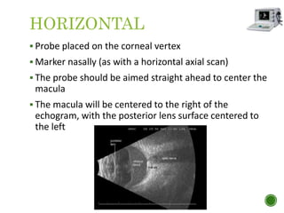 HORIZONTAL
 Probe placed on the corneal vertex
 Marker nasally (as with a horizontal axial scan)
 The probe should be aimed straight ahead to center the
macula
 The macula will be centered to the right of the
echogram, with the posterior lens surface centered to
the left
 