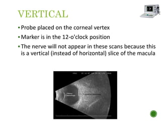 VERTICAL
Probe placed on the corneal vertex
Marker is in the 12-o'clock position
The nerve will not appear in these scans because this
is a vertical (instead of horizontal) slice of the macula
 