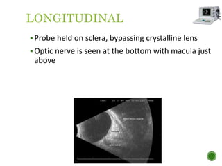 LONGITUDINAL
Probe held on sclera, bypassing crystalline lens
Optic nerve is seen at the bottom with macula just
above
 