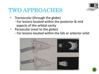 TWO APPROACHES
 Transocular (through the globe)
- For lesions located within the posterior & mid
aspects of the orbital cavity
 Paraocular (next to the globe)
- For lesions located within the lids or anterior orbit
 
