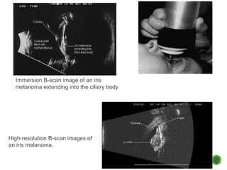 Immersion B-scan image of an iris
melanoma extending into the ciliary body
High-resolution B-scan images of
an iris melanoma.
 