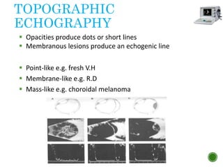 TOPOGRAPHIC
ECHOGRAPHY
 Point-like e.g. fresh V.H
 Membrane-like e.g. R.D
 Mass-like e.g. choroidal melanoma
 Opacities produce dots or short lines
 Membranous lesions produce an echogenic line
 