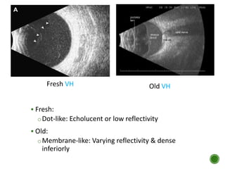  Fresh:
oDot-like: Echolucent or low reflectivity
 Old:
oMembrane-like: Varying reflectivity & dense
inferiorly
Fresh VH Old VH
 