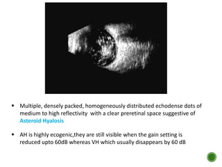  Multiple, densely packed, homogeneously distributed echodense dots of
medium to high reflectivity with a clear preretinal space suggestive of
Asteroid Hyalosis
 AH is highly ecogenic,they are still visible when the gain setting is
reduced upto 60dB whereas VH which usually disappears by 60 dB
 