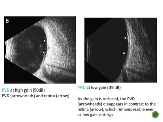PVD at high gain (90dB)
PVD (arrowheads) and retina (arrow)
PVD at low gain (39 dB)
As the gain is reduced, the PVD
(arrowheads) disappears in contrast to the
retina (arrow), which remains visible even
at low gain settings
 