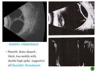 KISSING CHOROIDALS
 Smooth, dome shaped ,
thick, less mobile with
double high spike suggestive
of Choroidal Detachment
 