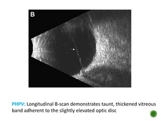 PHPV: Longitudinal B-scan demonstrates taunt, thickened vitreous
band adherent to the slightly elevated optic disc
 