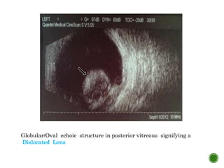 Globular/Oval echoic structure in posterior vitreous signifying a
Dislocated Lens
 