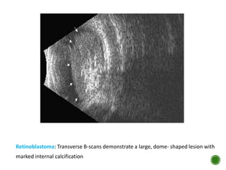 Retinoblastoma: Transverse B-scans demonstrate a large, dome- shaped lesion with
marked internal calcification
 