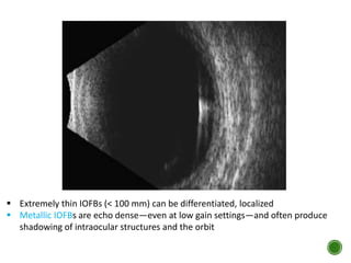  Extremely thin IOFBs (< 100 mm) can be differentiated, localized
 Metallic IOFBs are echo dense—even at low gain settings—and often produce
shadowing of intraocular structures and the orbit
 