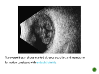 Transverse B-scan shows marked vitreous opacities and membrane
formation consistent with endophthalmitis
 