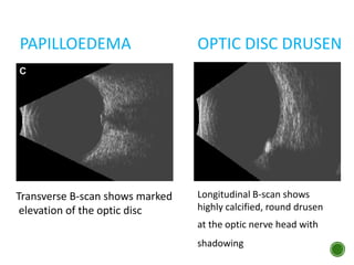 PAPILLOEDEMA
Transverse B-scan shows marked
elevation of the optic disc
OPTIC DISC DRUSEN
Longitudinal B-scan shows
highly calcified, round drusen
at the optic nerve head with
shadowing
 