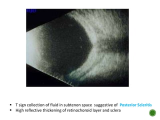 T sign collection of fluid in subtenon space suggestive of Posterior Scleritis
 High reflective thickening of retinochoroid layer and sclera
 