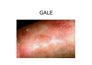 GALE
 