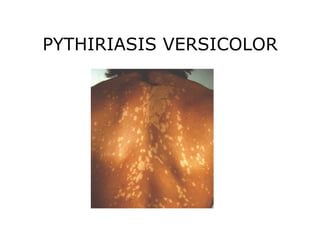 PYTHIRIASIS VERSICOLOR
 