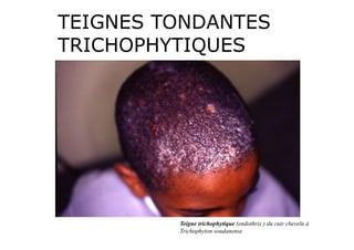 TEIGNES TONDANTES
TRICHOPHYTIQUES




         Teigne trichophytique (endothrix ) du cuir chevelu à
         Trichophyton soudanense
 