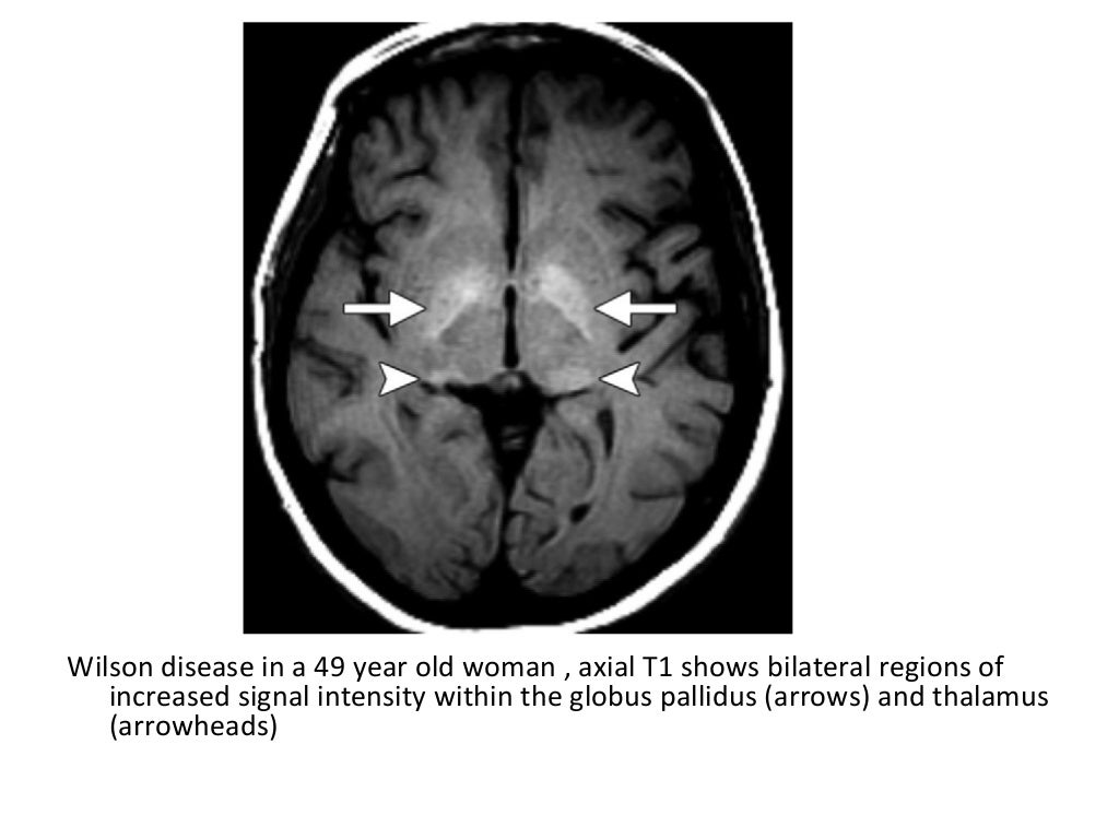 Diagnostic Imaging of Bilateral Abnormalities of the Basal Ganglia