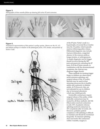 Figure 3.
Photographs at three months follow-up showing full active IP joint extension.




Figure 4.                                                                       of the IP joint. Notta’s node is a

                                                                                near the A1 pulley which typically




                                                                                absence of the extensor pollicus
                                                                                longus tendon, or arthrogryposis.
                                                                                A simple diagnostic test for trigger




                                                                                combination with the aforementioned
                                                                                symptoms, the clinician may
                                                                                diagnose trigger thumb.
                                                                                   Three methods for treating trigger

                                                                                serial extension splinting, and
                                                                                surgical release of the A1 pulley.
                                                                                Steroids may be used to treat

                                                                                adults and cautiously in diabetic

                                                                                not indicated for use in children
                                                                                due to hormonal alterations
                                                                                which may inhibit growth.
                                                                                   Irreducible contractures require
                                                                                surgical release of the pulley, while
                                                                                reducible contractures may be


                                                                                in only 10% of patients whereas




                                                                                to maintain and should be monitored
                                                                                frequently. If extension splinting

                                                                                within 3 months, surgery is

32   West Virginia Medical Journal
 