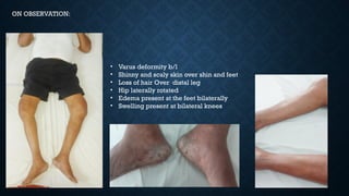 ON OBSERVATION:
• Varus deformity b/l
• Shinny and scaly skin over shin and feet
• Loss of hair Over distal leg
• Hip laterally rotated
• Edema present at the feet bilaterally
• Swelling present at bilateral knees
 
