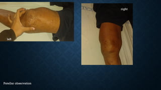left
right
Patellar observation
 