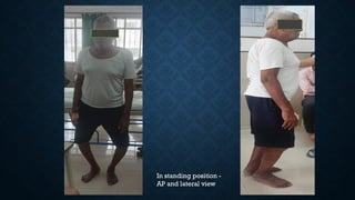 In standing position -
AP and lateral view
 