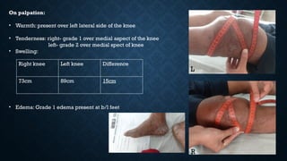 On palpation:
• Warmth: present over left lateral side of the knee
• Tenderness: right- grade 1 over medial aspect of the knee
left- grade 2 over medial spect of knee
• Swelling:
Right knee Left knee Difference
73cm 89cm 15cm
• Edema: Grade 1 edema present at b/l feet
L
R
 