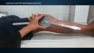 right Knee joint FFD-fixed flexion deformity
 
