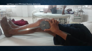 Left Knee joint FFD-fixed flexion deformity
 