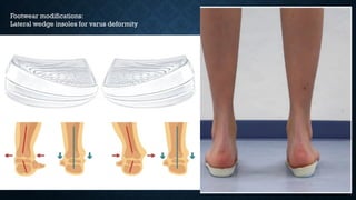 Footwear modifications:
Lateral wedge insoles for varus deformity
 