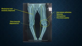• Joint space reduction
• Sclerosis
• Osteophytes
• Poor bone quality
Tibia Laterally
displaced b/l
Mechanical axis
medially displaced
 
