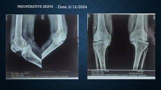 Date: 2/12/2024
PREOPERATIVE XRAYS :
 