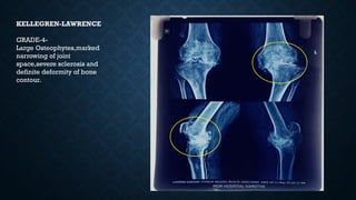 KELLEGREN-LAWRENCE
GRADE-4-
Large Osteophytes,marked
narrowing of joint
space,severe sclerosis and
definite deformity of bone
contour.
 